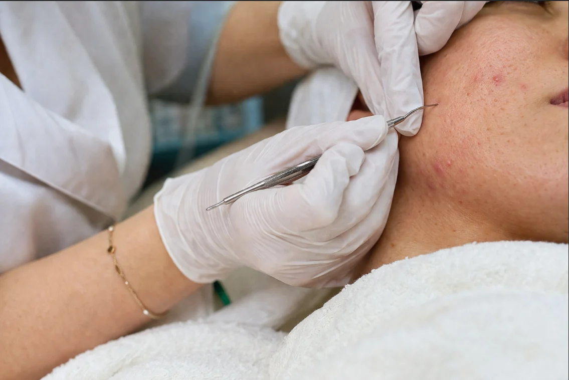 Cosmetic Surgery for Acne Scars