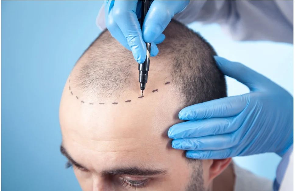 Hair Transplant & PRP / GFC