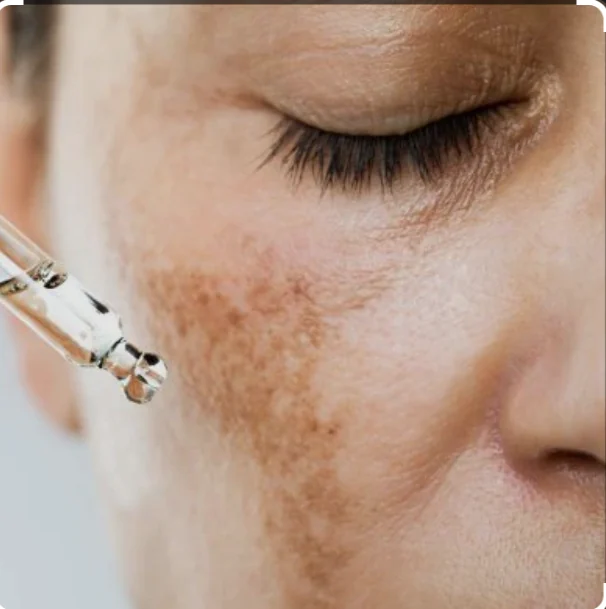 Hyperpigmentation Treatment