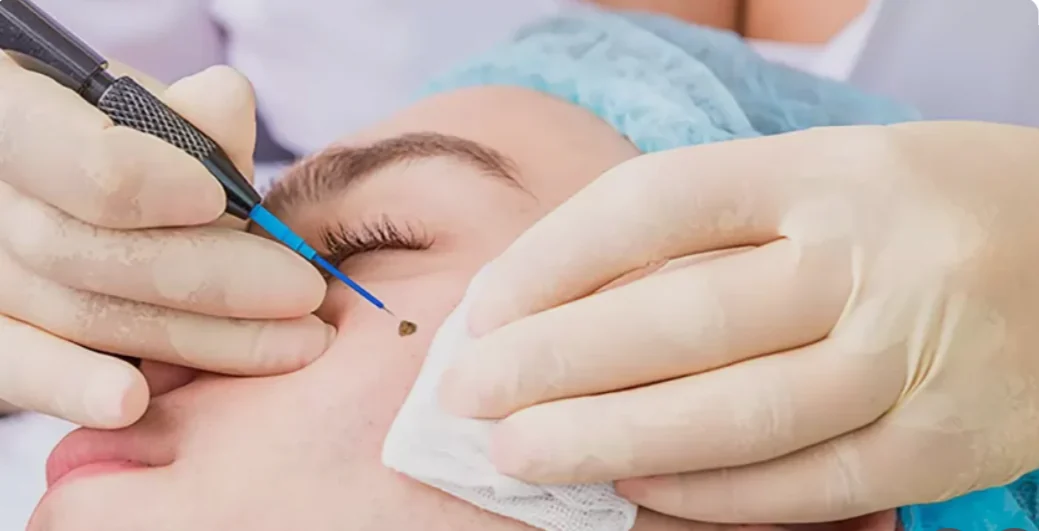 Radio Frequency Surgery