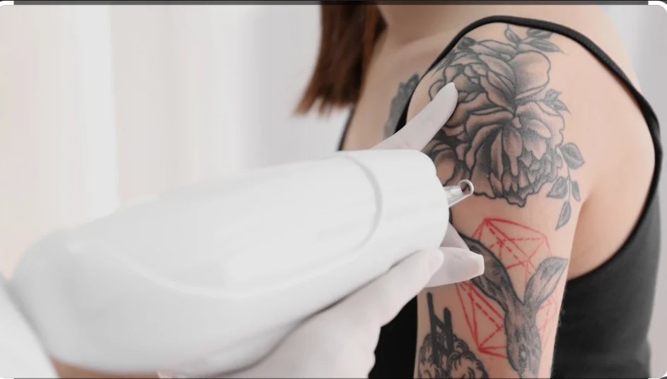 Tattoo Removal Laser